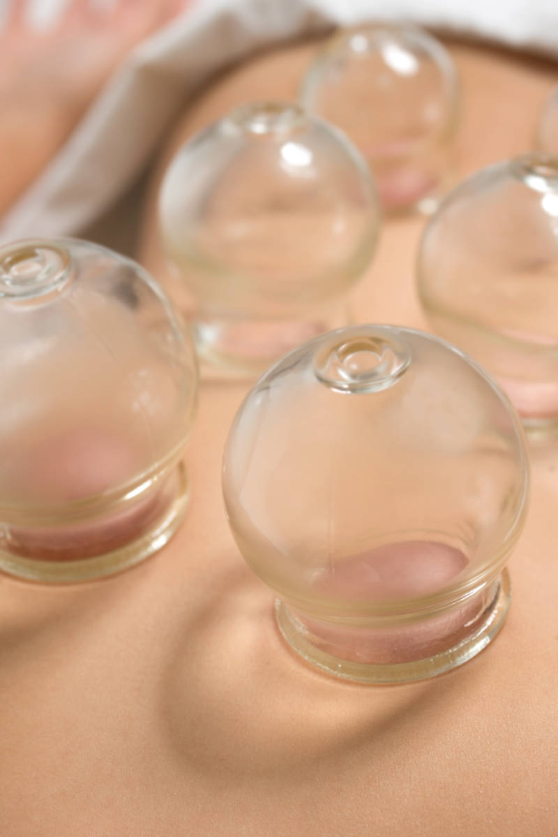 Ventouses en verre chauffées avec une flamme