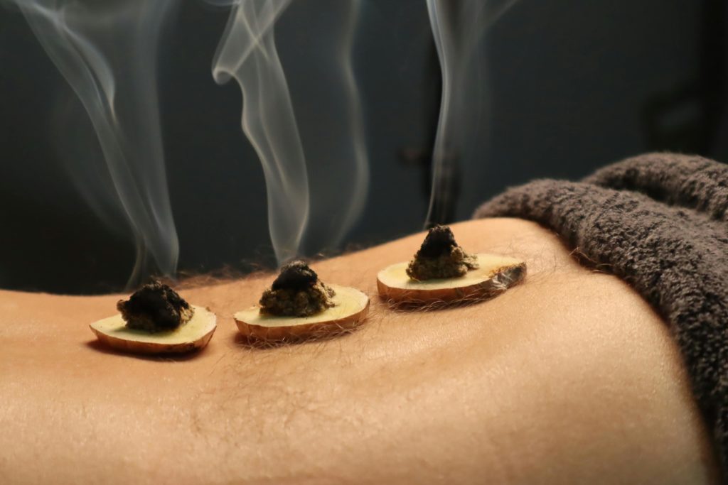 Moxibustion Moxibustion