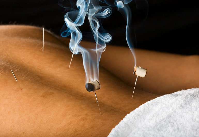 La moxibustion sur aiguille